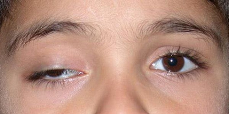 Tiêm botox bị sụp mí mắt ảnh hưởng tầm nhìn của mắt