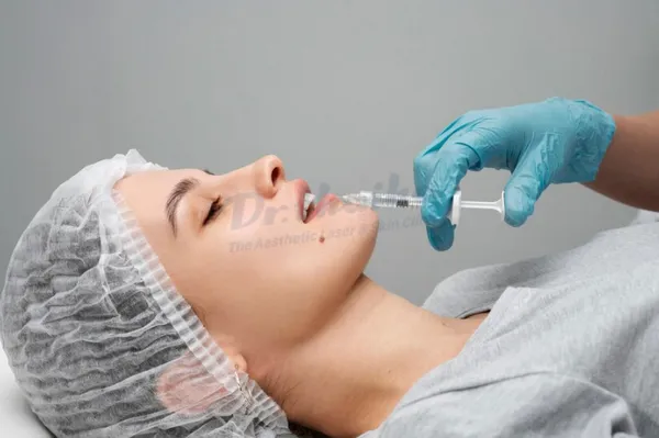 Dáng môi tiêm filler đẹp được chị em phụ nữ lăng xê nhiều nhất