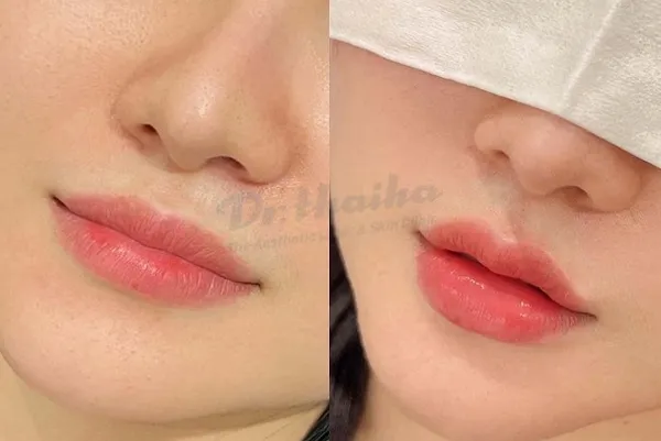 Tiêm filler môi ở đâu đẹp và an toàn