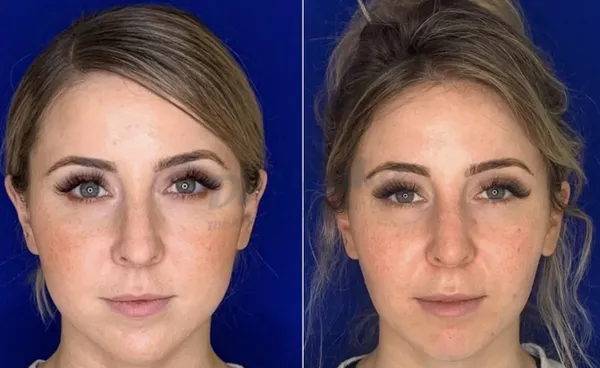 Những lưu ý trước và sau khi tiêm botox mà bạn cần biết