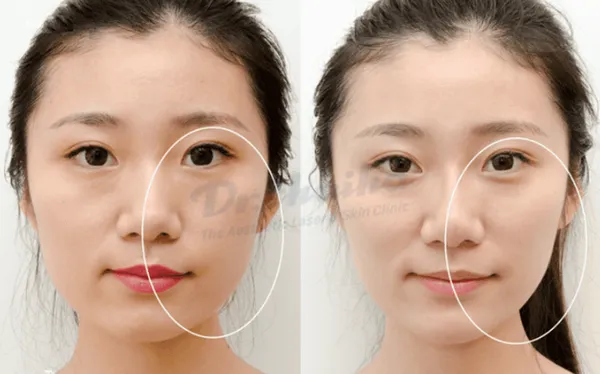 Sau khi tiêm botox thon gọn hàm nên kiêng gì?