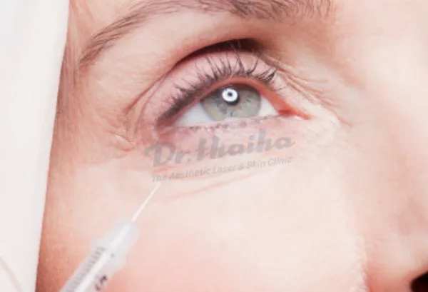 Sụp mí mắt do tiêm botox là do đâu? Xử lý ở đâu an toàn