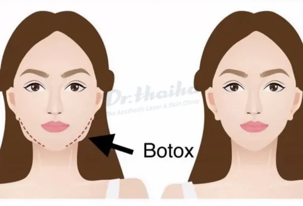 Tác dụng của tiêm botox gọn hàm có thể bạn chưa biết