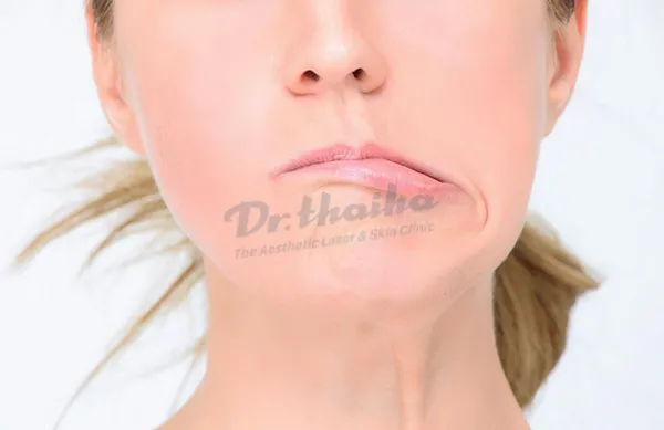 Tiêm botox bị lệch mặt phải làm sao? Chuyên gia chia sẻ