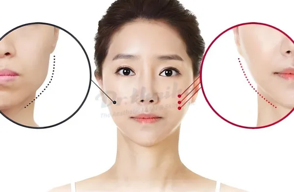 Tiêm botox có an toàn không? Địa chỉ uy tín tại Hà Nội