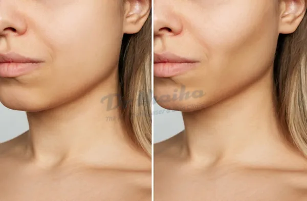 Tiêm botox gọn hàm có bị hóp má không, nên xử lý thế nào?