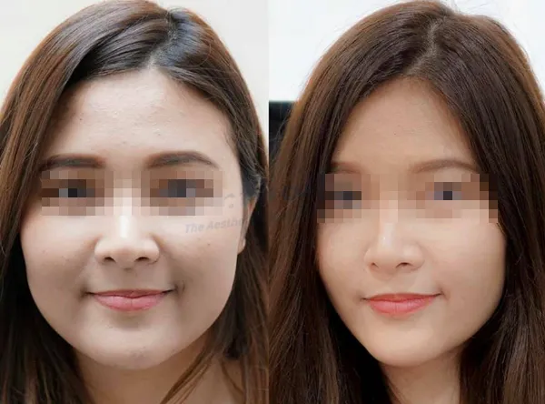 Tiêm botox hàm bao lâu có tác dụng? Giữ được bao lâu thì tiêm lại?