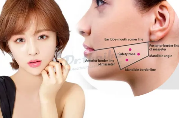 Tiêm botox hàm bao nhiêu tiền? Giá tiêm 2024