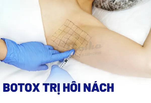 Tiêm botox trị hôi nách là gì? Giá tiêm botox bao nhiêu?