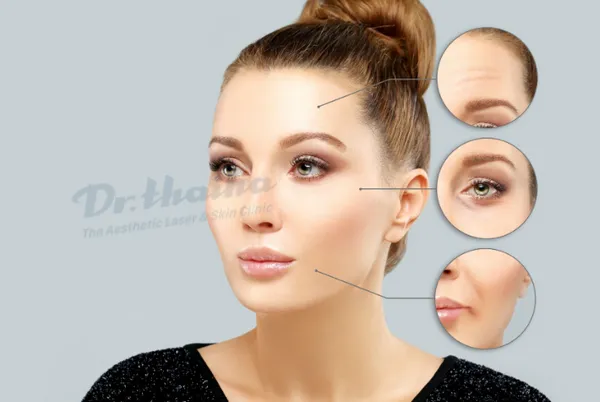 Tiêm botox xoá nhăn là gì? Có hại không