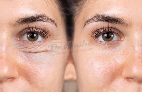 Tiêm botox xoá nhăn là gì? Có hại không