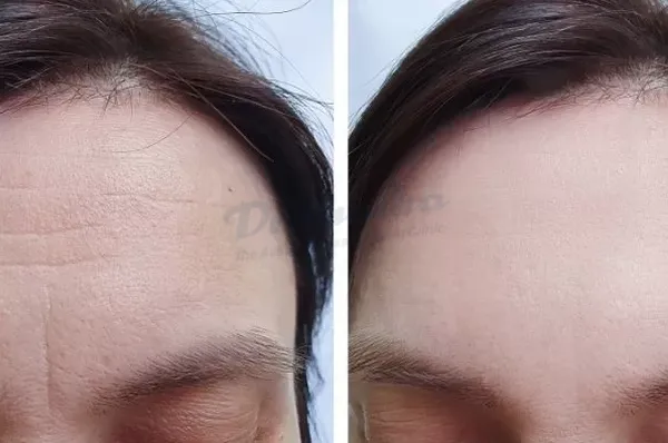 Tiêm botox xóa nhăn trán là gì? Giá bao nhiêu?