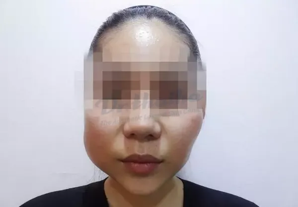 Tiêm filler mặt có hại về sau không? Chuyên gia chia sẻ