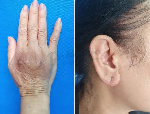 Vùng tiêm filler bị cứng phải làm sao?