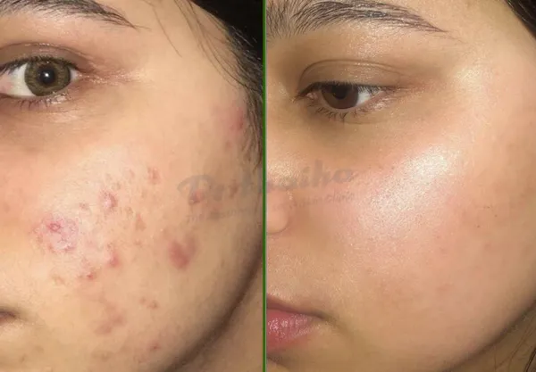 Peel da vi tảo retinol là gì? Có tốt không?