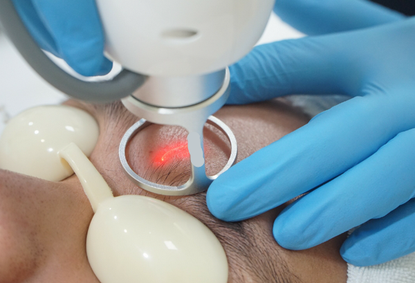 Điều trị sẹo thâm bằng công nghệ laser là gì? Có hiệu quả không