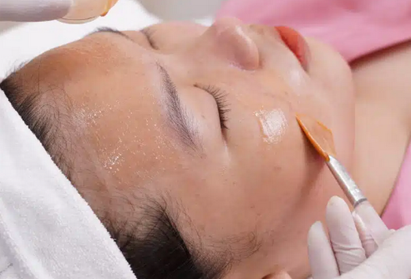 Mụn ẩn có peel da được không? Chuyên gia chia sẻ